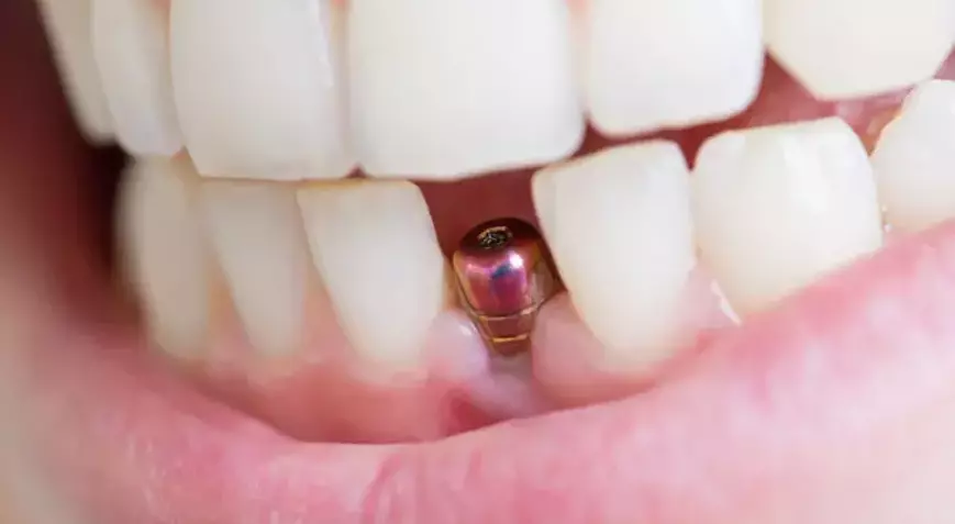 Ağrısız İmplant Tedavisi